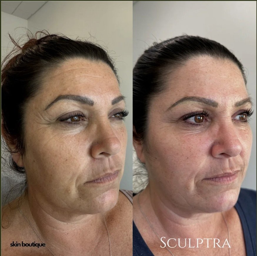 Rising Demand Drives Sculptra Adoption in Aesthetic Clinics